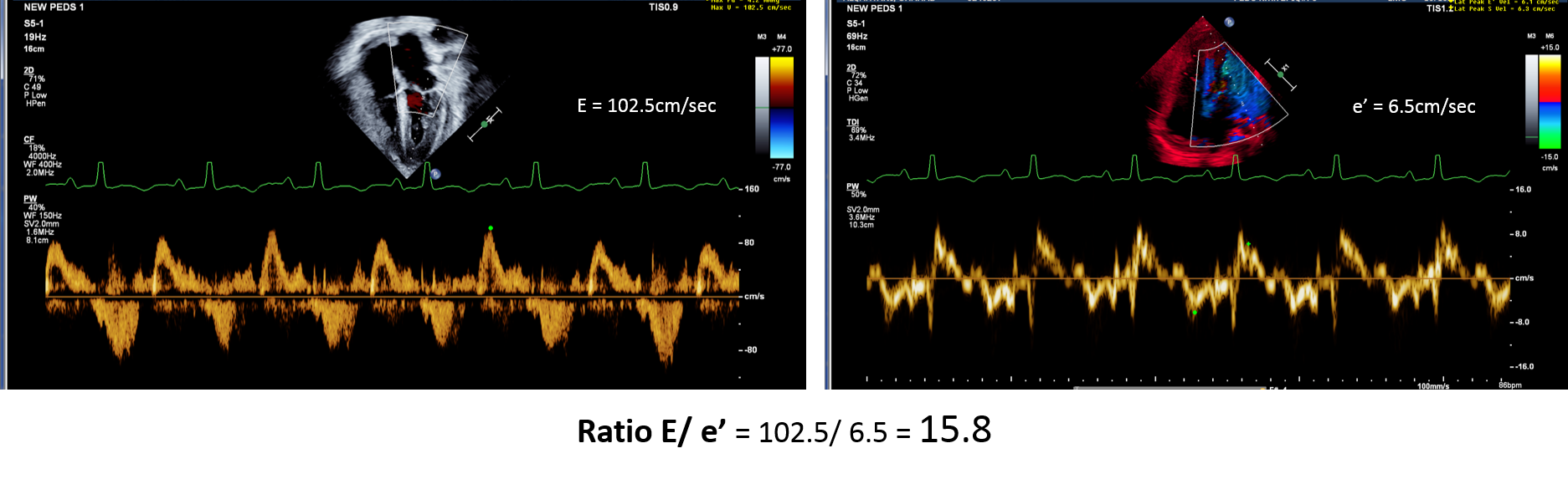 RatioE/e' in heart Tx